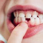 Молочный зуб скоро выпадет: лечить или ждать?